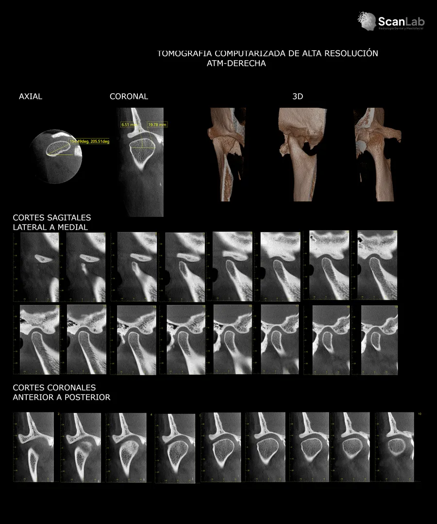 Tomografía de articulación temporomandibular con cortes sagitales, coronales y 3D