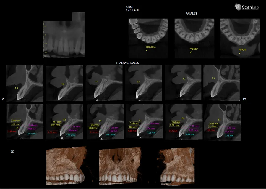 Estudio CBCT de biotipo periodontal con cortes axiales, transversales y reconstrucción 3D