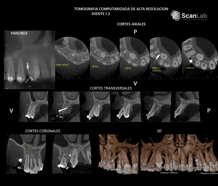 Estudio Cone Beam de alta resolución de una pieza dental, con cortes axiales, transversales y 3D