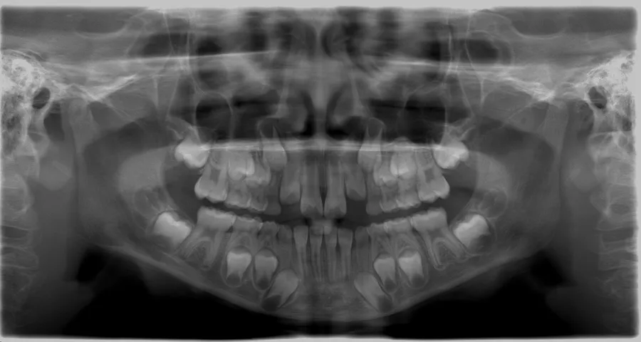 Radiografía panorámica digital tomada en ScanLab