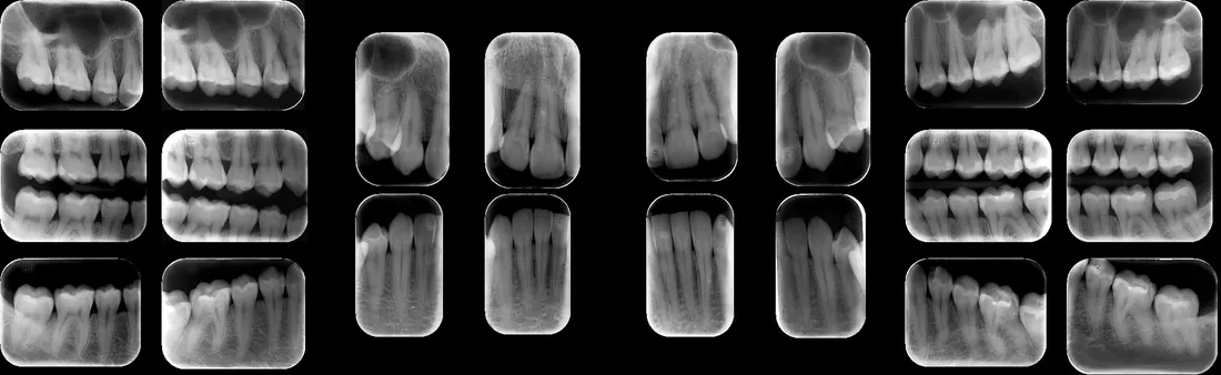 Radiografía periapical total y bitewing bilateral en formato digital