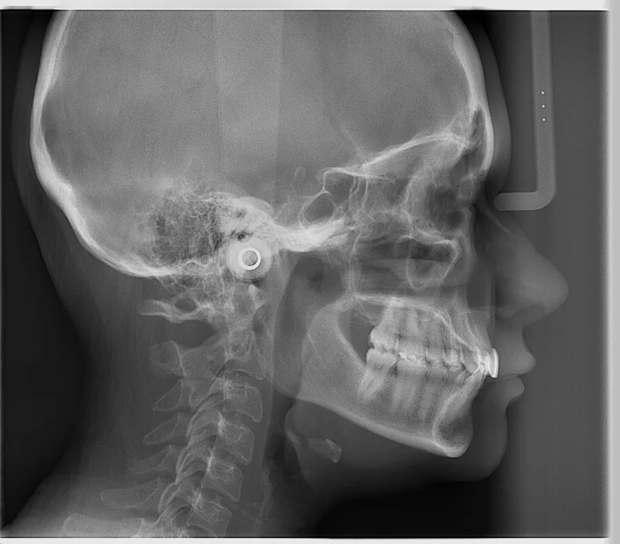 Telerradiografía lateral de cráneo tomada en ScanLab
